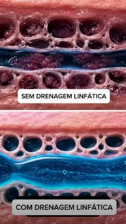 Ilustração comparando o tecido sem e com drenagem linfática
