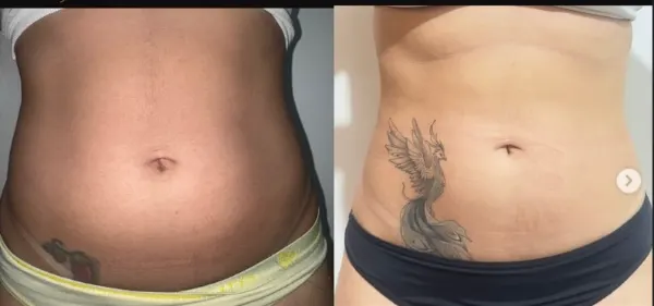 Antes e depois — Gordura localizada