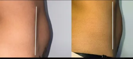 Após 1 sessão de criolipólise