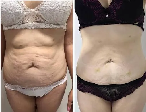 Antes e depois — Flacidez